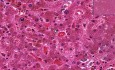 Liver - Hemochromatosis
