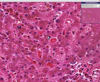 Liver - Hemochromatosis