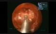 Endoscopic Transsphenoidal Transsellar Pituitary Excision