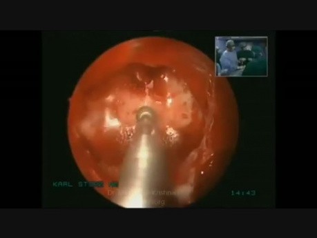 Endoscopic Transsphenoidal Transsellar Pituitary Excision