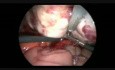 Laparoscopic Salpingo-oopherectomy for Large Dermoid With Severe Adhesion