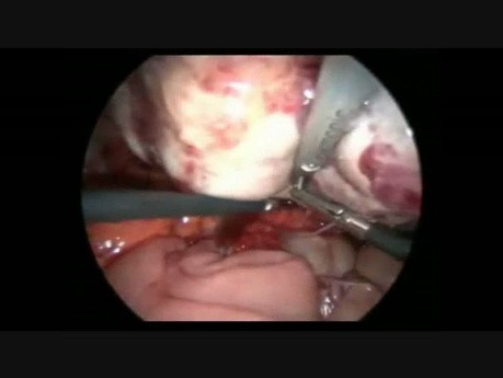 Laparoscopic Salpingo-oopherectomy for Large Dermoid With Severe Adhesion
