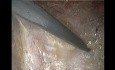 Laparoscopic Enhanced View Totally Exrta Peritoneal Ventral Hernia Repair