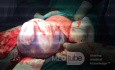 Cesarean Section in Twin Pregnancy 2