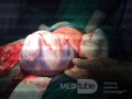 Cesarean Section in Twin Pregnancy 2
