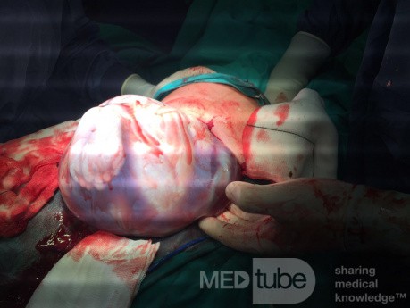 Cesarean Section in Twin Pregnancy 2