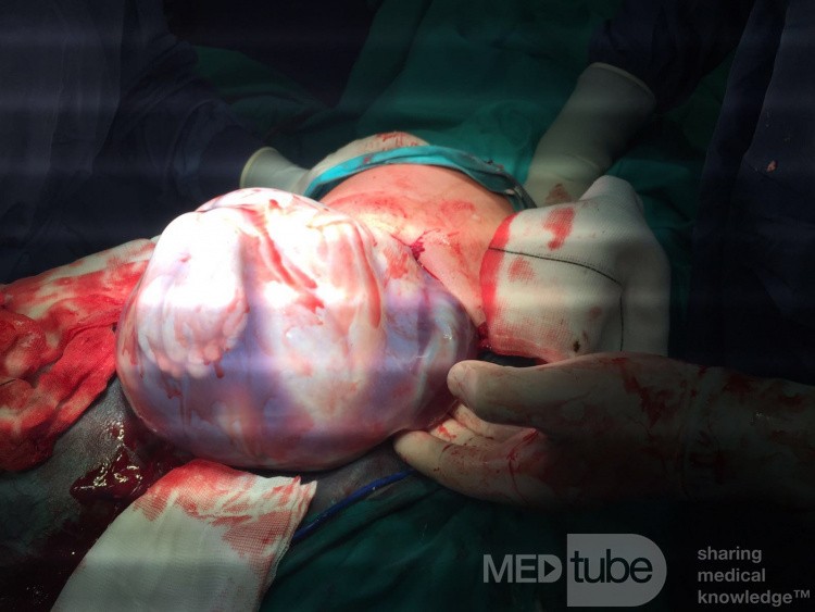 Cesarean Section in Twin Pregnancy 2