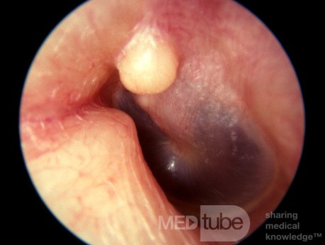 Solitary Exostosis