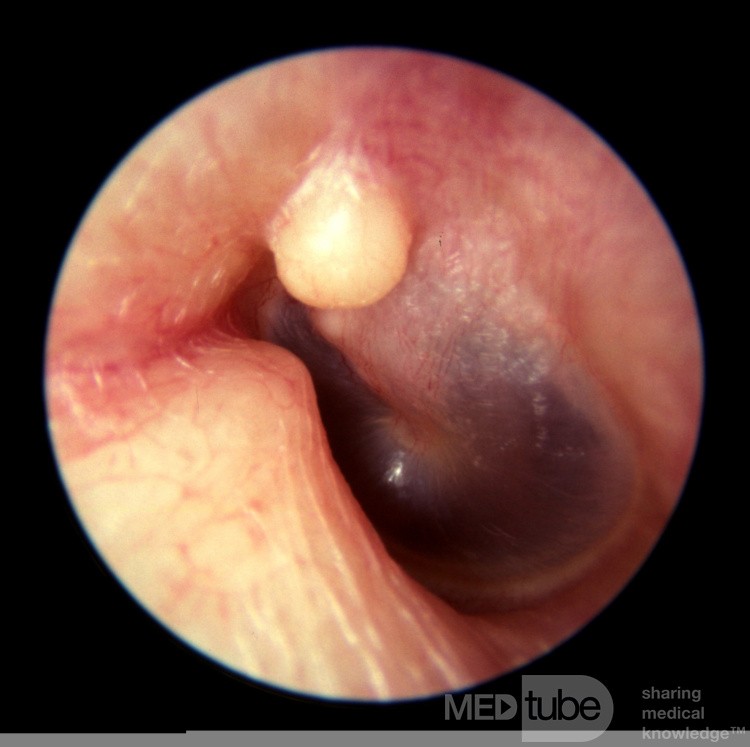 Solitary Exostosis
