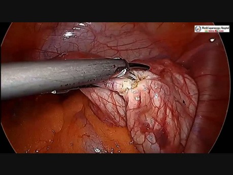 Laparoscopic Ovarian Cystectomy - Aspiration with Transparent Needle