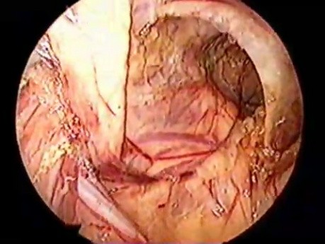 Totally transumbilical laparoscopic hernioplasty bilateral