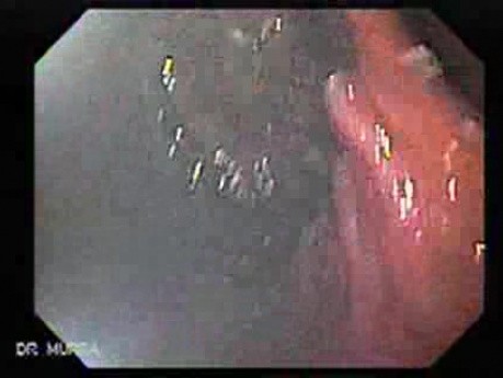 Adenocarcinoma of the Cardia and Carcinoma Epidermoid of the Larynx (25 of 26)