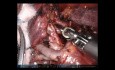 Robotic Pulmonary Tri-Segmentectomy of Left Upper Lobe