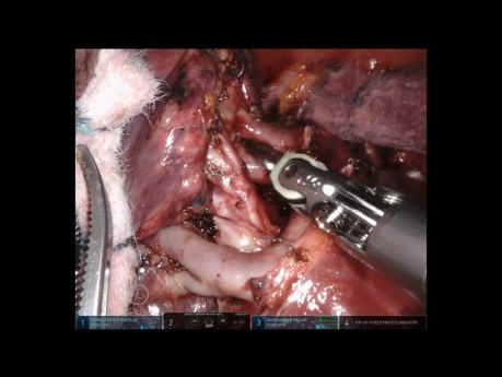 Robotic Pulmonary Tri-Segmentectomy of Left Upper Lobe