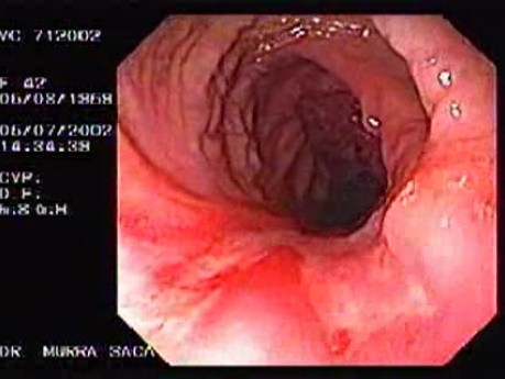 Crohn´s Disease (24 of 28)
