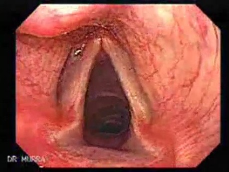 Vocal Cord and GERD