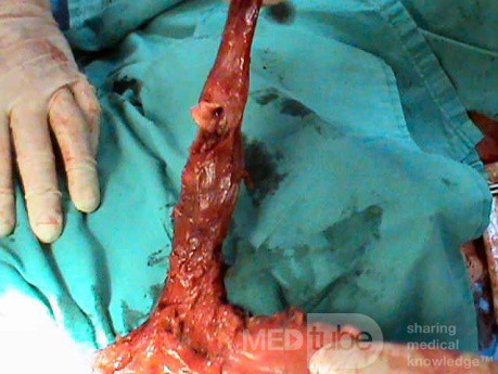 Barrett Adenocarcinoma - Endoscopic Image (15 of 20)