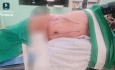Lap Right Adrenalectomy with LN for 5x5 cm Adrenal Mass