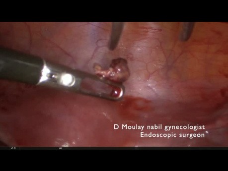Ectopic Pregnancy. Conservative Treatment.