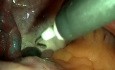 Laparoscopy for Polycystic Ovary Syndrome