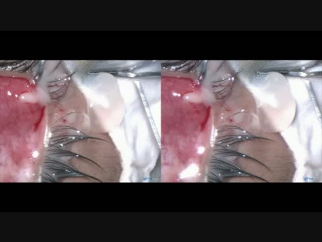 Cysticercus in Fornix, in a Child 7 y.o.