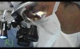 Rhinoplasty - Before And After The Nose Surgery