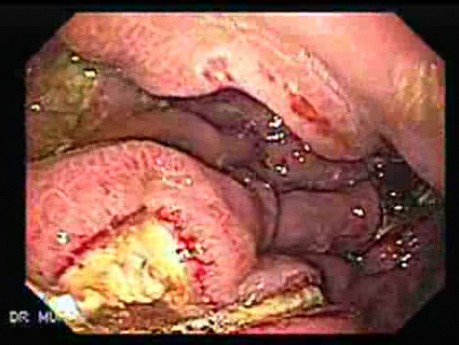 Presence of Multiple Irregular and Large Ulcers - 44 Years-Old Male