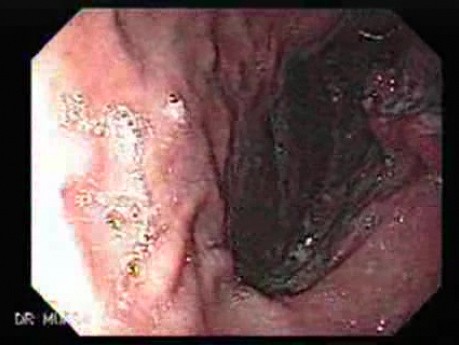Gastric Adenocarcinoma With Varices - Endoscopy (2 of 8)