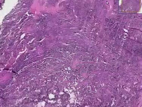 Alveolar rhabdomyosarcoma - Histopathology of skeletal muscle, face