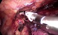  Thoracoscopic Esophagectomy 
