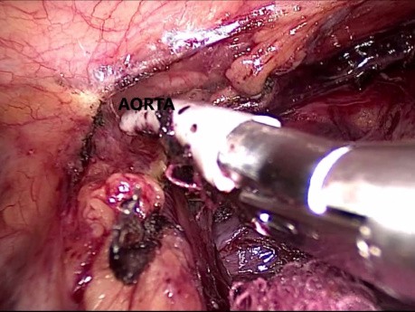  Thoracoscopic Esophagectomy 