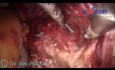 Total Laparoscopic Hysterectomy in Case of Pre CS