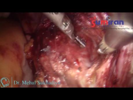 Total Laparoscopic Hysterectomy in Case of Pre CS