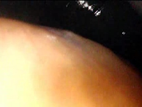 Gastrointestinal Stromal Tumor - GIST (36 of 65)