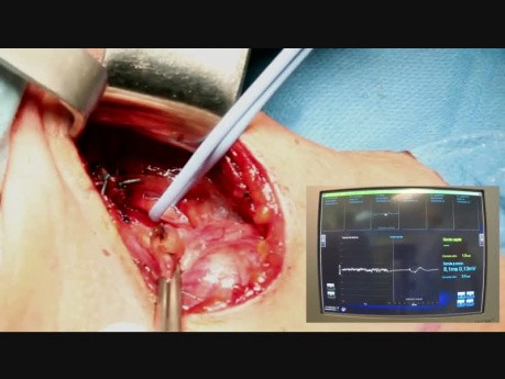 Thyroidectomy with Continuous Intraoperative Neuromonitoring (C-IONM) 