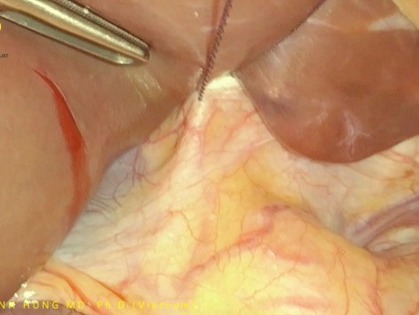 Liver Retraction