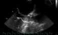 Tavi - Transcatheter Aortic Valve Implantation