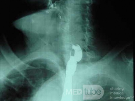 Zenker's Diverticulum  (7 of 8)