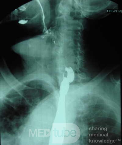 Zenker's Diverticulum  (7 of 8)