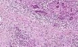 Adenocarcinoma - Histopathology of pancreas