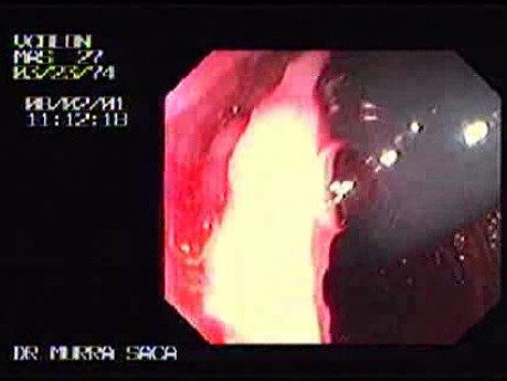 Familial Adenomatous Polyposis of the Colon (12 of 29)