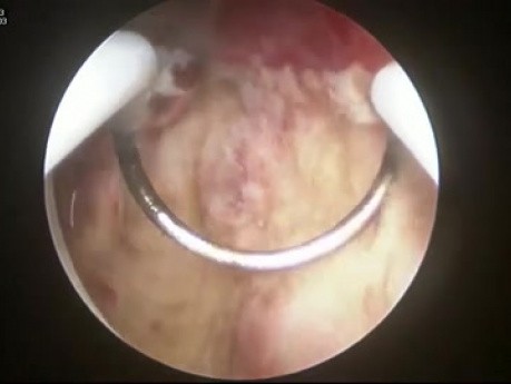 Endometrial Hyperplasia Hysteroscopic Resection