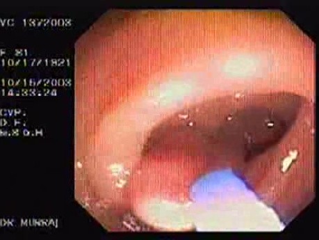 Tubulo - Villous Adenoma - Endoscopy (14 of 28)