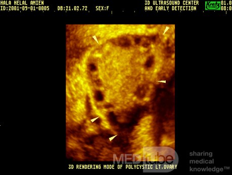 Poly Cystic Ovary By 3 Dimension US