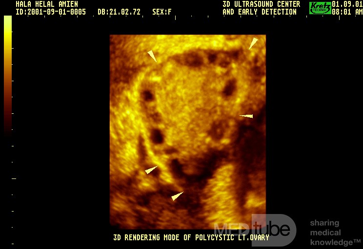 Poly Cystic Ovary By 3 Dimension US