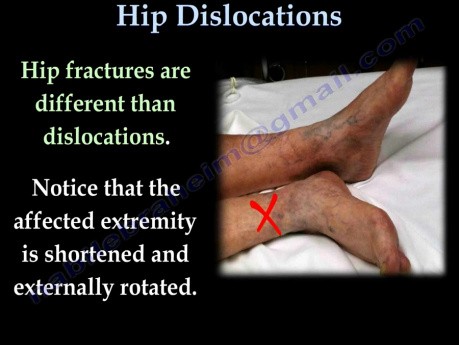 Hip Dislocations and Treatment - Video Lecture