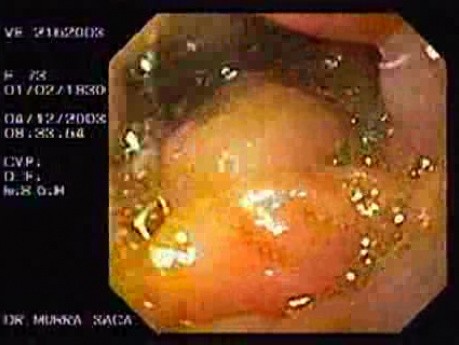 Duodenal B Cell Lymphoma (4 of 7)