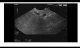 Endoscopic Ultrasound of Pancreatic Neuroendocrine Tumor
