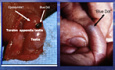 Acute Scrotum