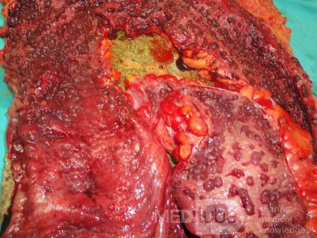 Multiple Rectal Ulcers (93 of 110)